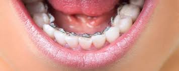 Die erste ursache des fehlbisses sind gekippte zähne. Innenliegende Zahnspange Info Kosten Arten Zahnspangensuche At