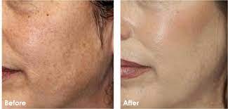 4 produk terbaik boleh melicin dan menghilangkan parut via 13 produk ini saya gunakan untuk pulihkan kulit muka via www.thereporter.my. Ubat Hilangkan Jeragat Rawatan P