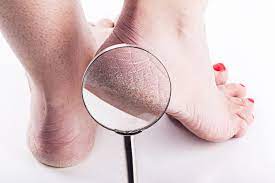 Suffering With Cracked Heels Put Your Feet In Our Hands