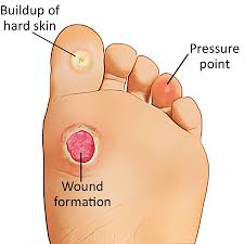 We did not find results for: How Diabetes Affects The Feet Healthxchange