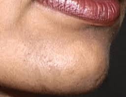 How To Get Rid Of Female Chin Hair By Dr Khurram Female Facial Hair Chin Hair Chin Hair Removal