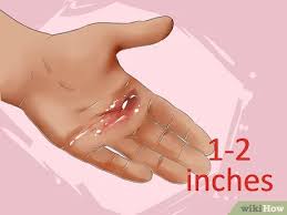 Placental membrane wound coverings featuring all native placental components. How To Treat Second Degree Burns Caused By Heat 13 Steps