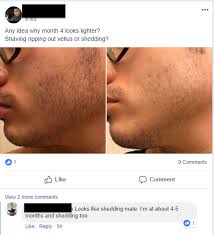 Minoxidil beard results after 1 month. Minoxidil Beard Can Men Grow Thicker Beards With Rogaine