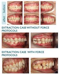 Cost of living in malaysia is cheaper than in 69% of countries in asia (9 out of 13). Clinical Case Before And After Whitesmile Clear The Clear And Affordable Invisible Braces