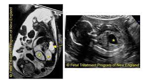 Fetal Urinary Tract Obstruction Facts And Treatments