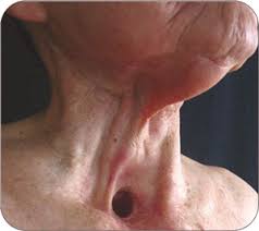 I had an on and off sore throat and hoarseness for many many months, but was a smoker, so didn't think too much about it. Who Smoking Causes Larynx Cancer