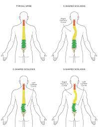 Scoliosis And Yoga The Do S And Don Ts Scoliosis Exercises Scoliosis Scoliosis Exercises Stretching