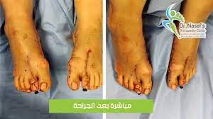 إصابات القدم والكاحل drnasef