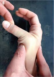 Disorder of the ligaments (chronic instability secondary to old. Aspetar Sports Medicine Journal Acute Finger Injuries In Handball