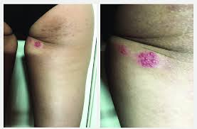 These attacks may, or may not, cause outbreaks of painful blisters on the skin. A And B A 28 Year Old Asian Woman With A Recurrent Hsv 1 Infection In Download Scientific Diagram