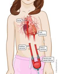 Learn the symptoms, causes and treatment of excess fluid around the heart. Congestive Heart Failure