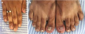 Image result for Yellow nail syndrome feet