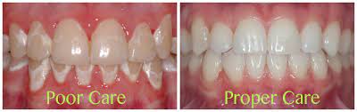 By then, the fluoride has already penetrated the dental enamel and will continue to protect the teeth for several months. Fluoride Varnish Can Help Prevent White Spots Khouri Orthodontics