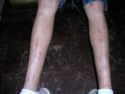 What Does A Poison Oak Or Poison Ivy Rash Look Like Poison Oak Poison Oak Rash Poison Ivy Rash