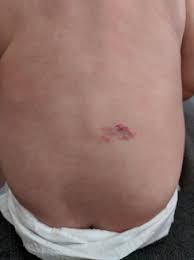 Sacral Dimple Crooked Buttcrack Spinal Birthmark Babycenter