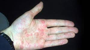 Dyshidrotic Eczema Causes Diagnosis Pictures