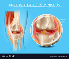 Injured Knee Joint With Torn Meniscus Chart