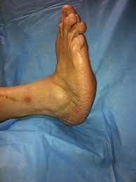 Charcot foot syndrome (cfs) is one of the more devastating complications affecting patients with diabetes and peripheral neuropathy. The Charcot Foot In Diabetes Diabetes Care