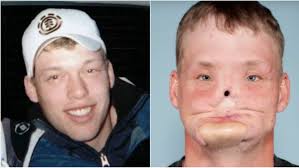 Andy genomgick ansiktstransplantation efter skadan