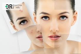 Nóng Gan có phải NGUYÊN NHÂN của Mụn nội tiết