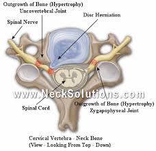 Check spelling or type a new query. Cervical Radiculopathy Pain Symptoms Treatment