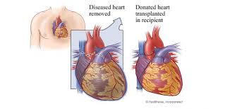 Image result for Transplantation