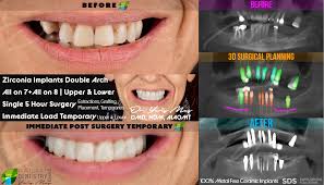 How to identify free dental implant scams. Zirconia Dental Implants Ceramic Implants Metal Free Dental Implants