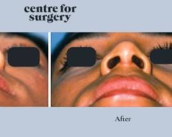 Image of person recovering from alarplasty surgery