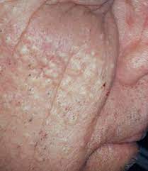 This transformative formula changes its consistency from cream to water once it hits the skin. Comedones Definition Of Comedones By Medical Dictionary