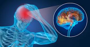 Image result for Postconcussion Syndrome