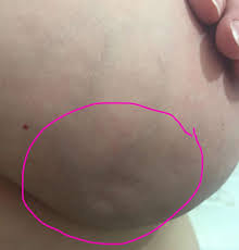 The american cancer society's warning signs and symptoms of breast cancer include: Breast Cancer It S Not Just Lumps What You Need To Know