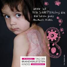Vor wenigen Tagen war der Tag des brandverletzten Kindes. Kennt Ihr noch  die richtigen Erste Hilfe Maßnahmen? 🚨Eine gute Gelegenheit, mal wieder  einen Erste-Hilfe-Kurs zu besuchen. 🤸Die Johanniter bieten jetzt auch Kurse
