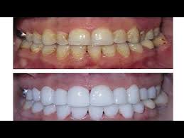 Voici Ce Qui Arrive Si Vous Plonger Vos Pieds En Vinaigre De Cidre Une Fois Par Semaine Comment Blanchir Les Dents Blanchir Les Dents Avoir Les Dents Blanches
