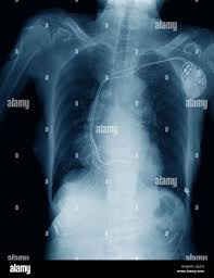 Image result for Pallidotomy