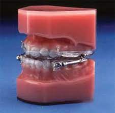 Herbst Appliance Dexter Orthodontics Dexter Mi
