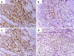 Tower of the moon full clear silver strawberry подробнее. Hyalinizing Clear Cell Carcinoma A Rare Entity In The Oral Cavity A Case Report