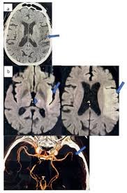 Image result for Thalamotomy