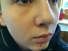 Image result for verrucae filiformes