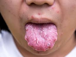 Most cases of throat (laryngeal) cancer occur in people aged over 60. What Are The Symptoms Of Throat Cancer In Malayalam