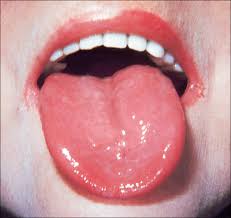 Image result for Erythroplakia roof of mouth