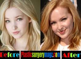 By the looks of dove cameron's instagram post from earlier this week, the actress and singer has gone for a drastically different look. Dove Cameron Before Plastic Surgery Pictures Plastic Surgery Magazine