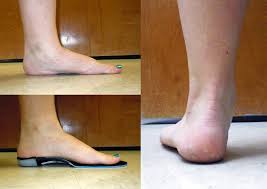 Maybe you would like to learn more about one of these? Evidence Based Orthotic Management Of Pttd Lower Extremity Review Magazine