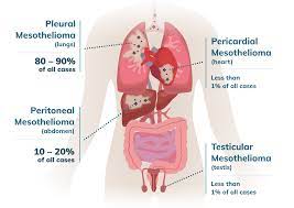However, there are common signs of the disease. 4 Types Of Mesothelioma Cell Location Cell Type And Treatment