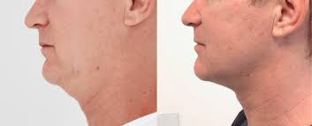 Are there any risks of having ultherapy treatment? How Ultherapy Corrects Jowls And Sagging Skin Russak Plus New York City New York