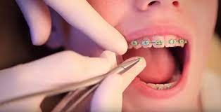 In spring, mint green, petal pink, and robin's egg. 8 Fun Braces Color Combinations For Summer Orthodontics Limited