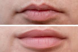 The added benefit of mannitol keeps free radicals at bay without causing pain or any distress to the layers of the skin. Lip Fillers How Long Do They Last How Much Do They Cost And Everything Else You Need To Know Closer