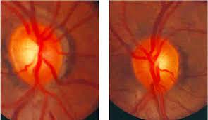 Optic nerve photos and scans. Glaucoma Tests And Diagnosis