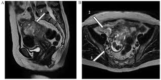 A ct scan or mri may be conducted of your pelvic region to rule out other obstructions or masses, as written in this interesting article on the usefulness of a biopsy found it was an endometriosis lesion, the same was visible on that last ct scan. Intravenous Low Grade Endometrial Stromal Sarcoma With Intracardiac Extension A Case Of Inaccurate Tumor Location On Contrast Enhanced Computed Tomography