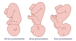 Image result for Brow Presentation