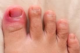 Image result for Toenail Removal